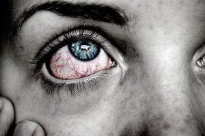 Burning eyes Causes, Diagnosis and Treatment