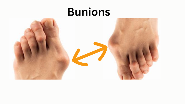 Causes, Symptoms and Treatment of Bunions