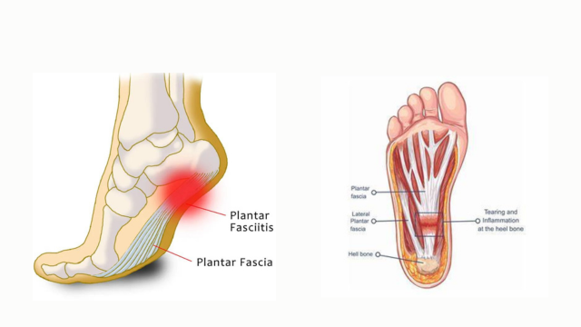 How to treat Plantar Fasciitis and Best Shoes for Plantar Fasciitis