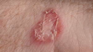 10 Best Home Remedies to Cure Ringworm