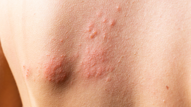 Shingles – Causes, Symptoms and Treatment