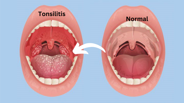 Is Tonsilitis Contagious