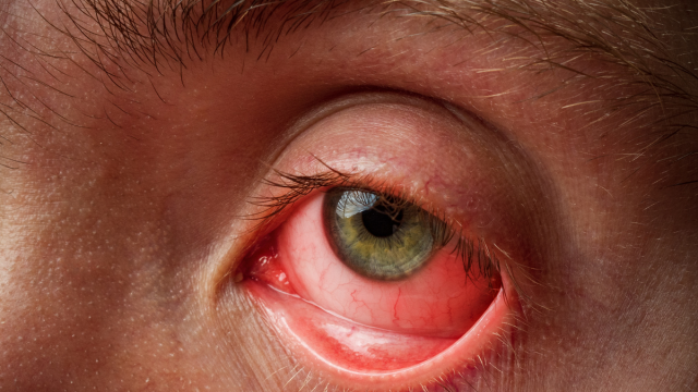 Conjunctivitis causes, symptoms and treatment