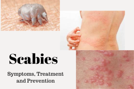 Scabies: Symptoms, Treatment And Prevention - Kechyelathrive