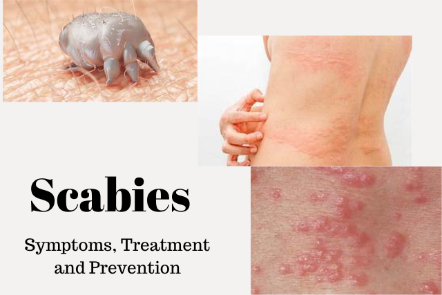 Scabies: Symptoms, Treatment and Prevention