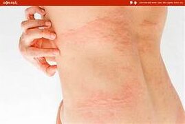 15 Effective Home Remedies for Scabies: Natural Solutions for Itching Relief