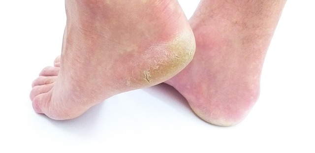 Overview of Athlete’s Foot: Causes, Symptoms, Prevention, and Treatment