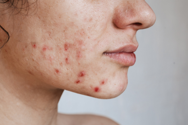 15 Most Effective Home Remedies for Acne
