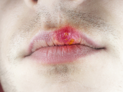 Cold Sores: Causes, Symptoms, and Treatment Options